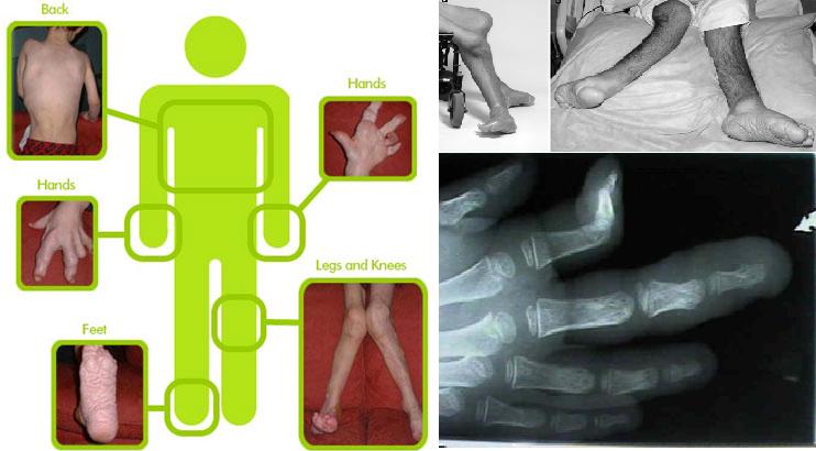 Effects of Proteus syndrome